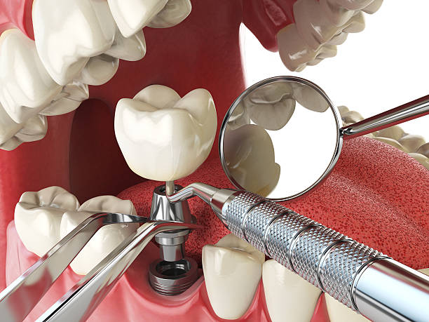 Best Emergency Tooth Extraction in Ridgely, MD